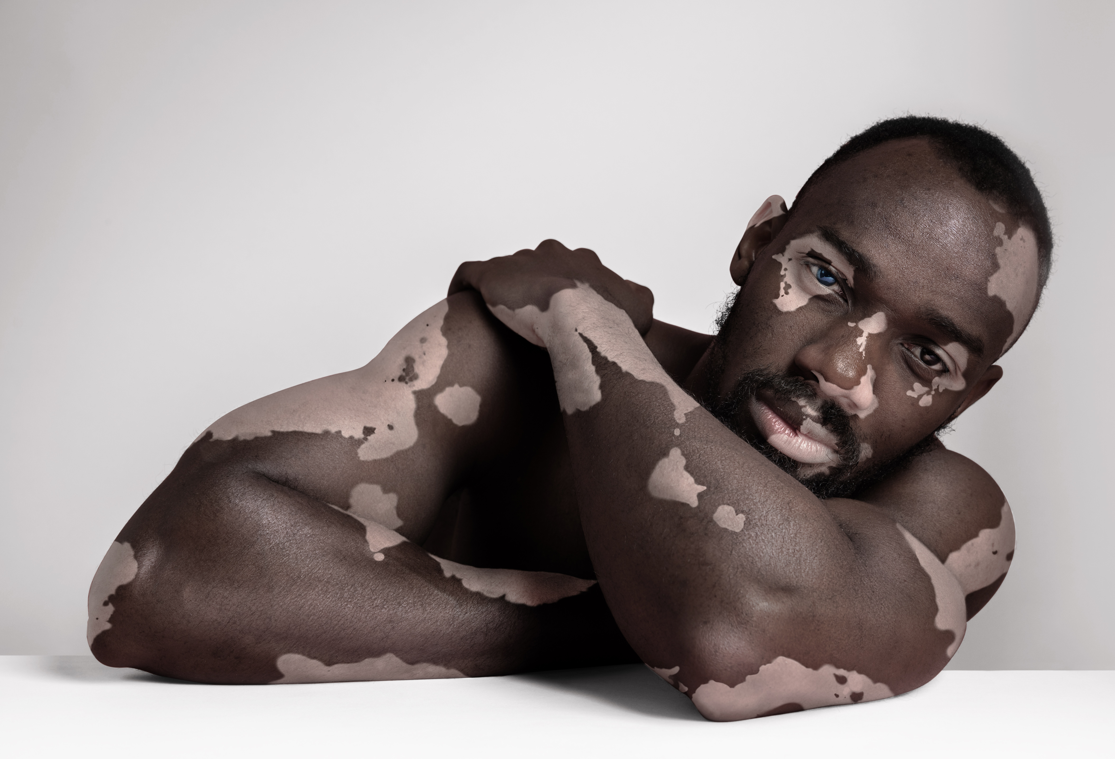 Beauty in Pigmentation